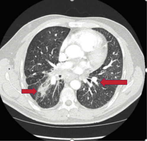  Die CECT (contrast-enhanced computerized tomography, kontrastverstärkte Computertomographie)-Brustqueransicht (rote Pfeile) zeigt Knötchen mit ausgedehnter Fibrose.