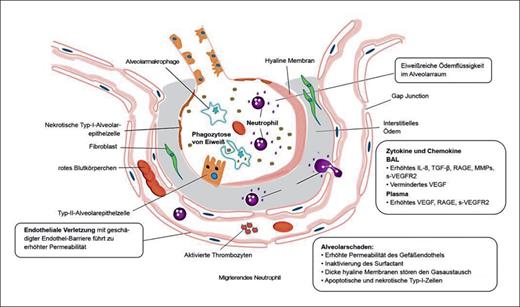 Fig. 4. Exsudative Phase des ARDS.