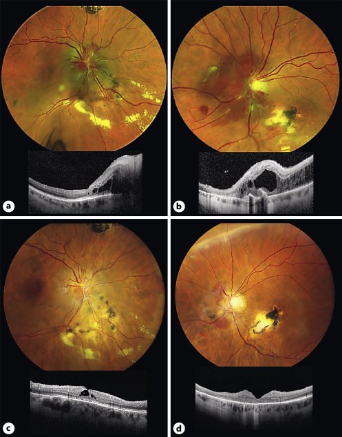  Ansprechen auf Belzutifan bei einem Patienten mit VHL-assoziierten bilateralen retinalen Hämangiomen. Farbfundusfotografien und optische Kohärenztomografie (OCT) des (a) rechten und (b) linken Auges eines Patienten mit beidseitigen Papillenangiomen und damit verbundenem zystoiden Makulaödem, das mit einer Kombination aus PDT-Laser, fokalem Laser, intravitrealem Anti-VEGF und intravitrealen und subtenonalen Steroiden an beiden Augen sowie externer Bestrahlung am rechten Auge behandelt wurde. Farbfundusfotografien und OCT-Bilder des (c) rechten und (d) linken Auges des Patienten nach 9-monatiger Behandlung mit systemischem Belzutifan, mit Rückbildung der Tumoren und deutlicher Verbesserung des zystoiden Makulaödems in der OCT. Aus [6].