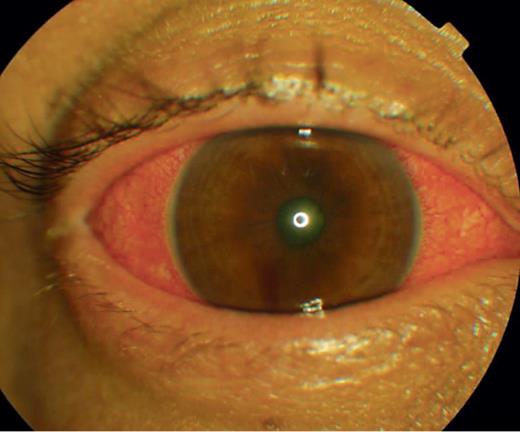 Fig. 1. Rechtes Auge bei Vorstellung 14 Tage nach Beginn der Fingolimod-Therapie wegen schubförmig-remittierender multipler Sklerose mit konjunktivaler Gefäßinjektion und verengter Pupille und ohne eitrige Sekretion.
