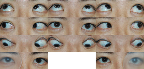 Abb. 1. Fotografien in 9 Blickrichtungen ergaben normale Duktionen und Versionen. Allerdings zeigte die Patientin im alternierenden Prismenabdecktest einen Downbeat-Nystagmus und eine Hypertropie von 6 Prismen-Dioptrien rechts.