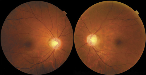 Abb. 2. Fundus-Photographien zeigten eine leichte Inzyklotorsion im rechten Auge und ein normales linkes Auge.