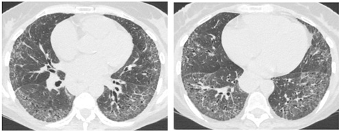 TC del tórax – ventana pulmonar – que muestra un engrosamiento intersticial fino bilateral y opacidades en vidrio esmerilado con predominio basal, bronquiectasias de tracción mínimas y preservación subpleural relativa (patrón NSIP).
