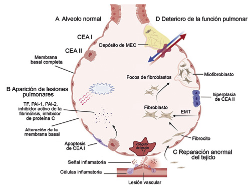  El proceso patológico de la fibrosis pulmonar idiopática. (a) Cuando los alveolos normales se dañan y se reparan anormalmente, se produce un deterioro irreversible de la función pulmonar. El alveolo normal presenta una membrana basal completa y una función de intercambio gaseoso. (b) Cuando la continuidad de la membrana basal se interrumpe por una lesión externa, los capilares dañados y las CEA activadas liberan señales inflamatorias y factores de coagulación, generando un microambiente inflamatorio local. (c) Si el daño persiste, se iniciará una reparación anormal. Los progenitores mesenquimales pulmonares, fibrocitos reclutados en el pulmón y las células endoteliales sometidas a EMT pueden agregarse para formar focos de fibroblastos y diferenciarse en miofibroblastos secretores de matriz. Para equilibrar el suministro local de sangre a los alveolos, se forman gradualmente nuevos vasos sanguíneos. (d) Conforme aumenta el número de focos de fibroblastos, se deposita más MEC y ésta se reticula, lo que desencadena un deterioro de la distensibilidad pulmonar y de la función de intercambio gaseoso.