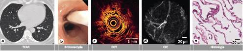  Ejemplos de imágenes normales del parénquima pulmonar con diferentes técnicas de imagen y patología. (a) TCAR del parénquima pulmonar normal. (b) Imagen con luz blanca de las vías respiratorias durante una broncoscopía, en la que se visualiza el catéter de CLE en el pulmón derecho. (c) Imagen por OCT de alveolos normales con septos alveolares finos (p: sonda OCT). (d) Imagen por CLE de alveolos normales en la que se visualizan fibras de elastina autofluorescentes. (e) Histología de una biopsia pulmonar en un paciente con EPI de parénquima pulmonar sin anomalías en la evaluación patológica.
