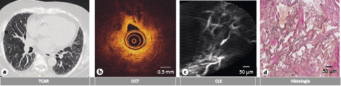  (a) TCAR no-concluyente con reticulación como patrón dominante. (b) La imagen por OCT visualizó las características de la fibrosis pulmonar homogénea, con pérdida de los espacios aéreos alveolares. (c) Imagen por CLE en mosaico de una zona pulmonar, en la que se visualiza un aumento en el número de fibras de elastina. (d) Imagen histológica de la biopsia pulmonar correspondiente con fibrosis distribuida homogéneamente en un paciente con diagnóstico final de neumonía idiopática fibrótica inespecífica.