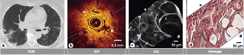  (a) Exploración por TCAR no-concluyente con reticulación como patrón dominante. (b) Las imágenes por OCT visualizaron las características de la fibrosis pulmonar en parches (*) con estructuras alveolares adyacentes conservadas, pero distorsionadas y engrosadas en el lado derecho de la sonda de imagen (#). (c) Imagen por CLE en mosaico de un área pulmonar, visualizando de forma similar un área sospechosa de fibrosis (*) (aumento de las fibras de elastina, con pérdida de la arquitectura alveolar) alternada con un área con estructura alveolar preservada (#). (d) Imagen histológica de la correspondiente biopsia pulmonar con fibrosis en parches en un paciente con diagnóstico final de cHP.