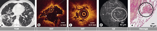  (a) TCAR con nódulos como patrón dominante. (b) Imagen por OCT de una vía respiratoria con visualización de dos lesiones elevadas con sombra por debajo, en un paciente con diagnóstico final de sarcoidosis. La biopsia correspondiente de la vía respiratoria reveló granulomas. (c) Imagen por OCT del compartimento alveolar de la paciente, con nódulos como imagen dominante de la TAC, que muestra una reducción de los espacios alveolares cargados con aire. Imagen por CLE (d) de una estructura redonda de bajo contraste (círculo) con la imagen histológica (e) de la biopsia pulmonar correspondiente, con un granuloma y fibrosis en un paciente con diagnóstico final de silicosis.