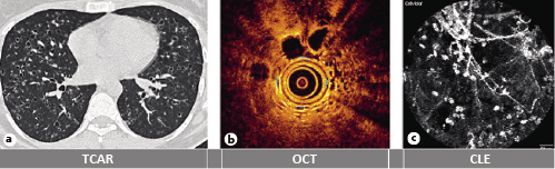  (a) Imagen de TCAR con quistes como patrón dominante en una mujer joven con antecedentes de tabaquismo, típico de la LCH. (b) Imagen de OCT del parénquima pulmonar con visualización de la extensión difusa de grandes espacios aéreos de forma redonda, correspondientes a los quistes. (c) Imagen CLE del compartimento alveolar que muestra la presencia de una gran cantidad de células autofluorescentes de gran tamaño (que dificultan la clara visualización de las estructuras alveolares) El LBA de los segmentos correspondientes del pulmón reveló la presencia de macrófagos y pocas células CD1a+ positivas.