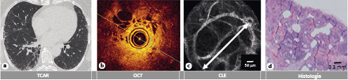  (a) Una TCAR no-concluyente con reticulación y quistes (forma de panal) como patrón dominante. (b) Imagen por OCT del parénquima pulmonar que visualiza el engrosamiento de los septos alveolares y el panal microscópico (*). (c) Imagen por CLE del compartimento alveolar que muestra la presencia de una abertura ensanchada de un alveolo. (d) Con la biopsia correspondiente que muestra fibrosis pulmonar densa en un paciente diagnosticado con cHP. *Este caso se discutió en un comité nacional de EPI, en el que se habló de que la distribución de la fibrosis y el panal de abejas podrían sugerir una UIP; sin embargo, los focos de fibroblastos no estaban presentes en la histología. Además, en la histología se encontraron zonas con infiltrados densos con eosinófilos y células gigantes. La comisión nacional concluyó que las imágenes de la TCAR junto con los hallazgos histológicos se clasificarían mejor como una forma de neumonitis por hipersensibilidad.