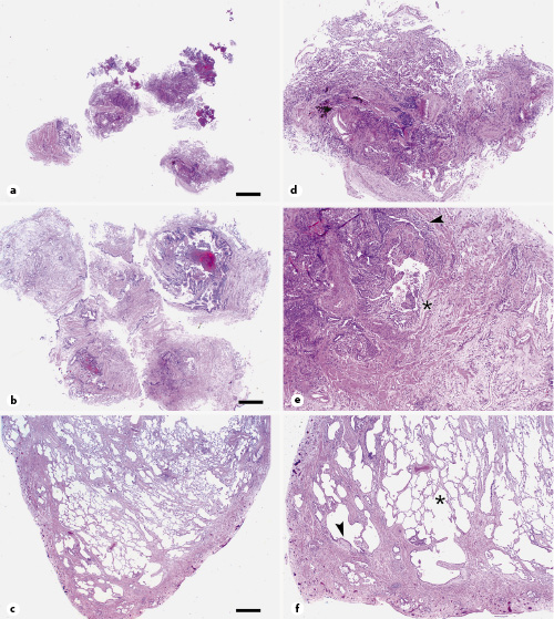  Secciones tisulares rutinarias teñidas con H&E que muestran los métodos de muestreo pulmonar, incluyendo biopsia transbronquial con fórceps (a), criobiopsia transbronquial (b) y biopsia en cuña por VATS (c). (a-c) × 1; barra de escala, 1 mm. Biopsia transbronquial con fórceps con cicatrización parenquimatosa en parches, pero con información insuficiente para asegurar el diagnóstico de EPI (d). Criobiopsia transbronquial con áreas de remodelación parenquimatosa más amplia y áreas sugestivas de cambios en forma de panal (*) y un foco de fibroblastos (flecha) (e). Biopsia en cuña por VATS que muestra los rasgos característicos de la neumonía intersticial habitual, incluida la heterogeneidad espacial con fibrosis subpleural junto con un tejido pulmonar subyacente relativamente normal (*) y un cambio en forma de panal temprano con focos de fibroblastos (flecha) (f). (d, e) × 4; (f) × 2. EPI, enfermedad pulmonar intersticial; H&E, hematoxilina y eosina; VATS, cirugía toracoscópica asistida por video.