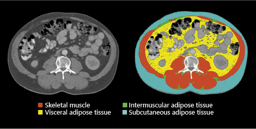 Fig. 1. Computed tomography body composition analysis of the third lumbar vertebrae.