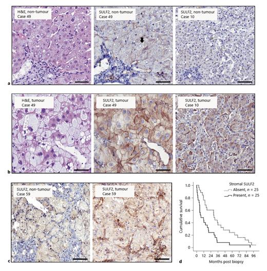 Fig. 1. SULF2 expression in non-tumour liver and HCC tumour cells predicts prognosis: Representative images show H&amp;E staining and SULF2 IHC in non-tumour (a) and tumour paired tissues (b). In non-tumour liver, SULF2 was expressed on the canalicular surface hepatocytes (black arrow), hepatic arterioles (a), endothelial cells (e), and occasional nonparenchymal sinusoidal cells (white arrows). In the tumour, cytoplasmic (right image) and membranous SULF2 (middle image) was increased in neoplastic cells. c Images show SULF2 IHC in non-tumour and tumour paired tissue. SULF2 was upregulated in CAFs in tumour tissue as compared to minimal expression in non-tumour stroma. Images are ×20 magnification and scale bars represent 50 microns. d Survival of patients with stromal SULF2 present in their tumour was markedly reduced (median 7.2 months) compared to patients in whom it was absent/scanty (median 29.2 months; Kaplan-Meier, p= 0.003).