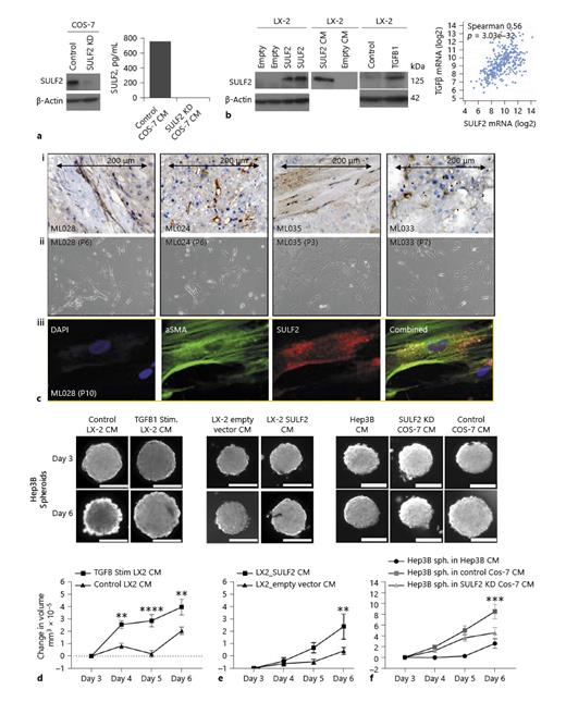 Fig. 2. SULF2 is expressed by CAFS isolated from SULF2 stromal positive tumours, with SULF2 conditioned media stimulating growth of 3D Hep3B spheroids in vitro. a SULF2 was highly expressed in COS-7 cells and suppressed by SULF2 shRNA, assessed by Western blot and ELISA assay. b Western blot of LX-2 whole cell lysates showing LX-2 cells with little SULF2 (left panel). SULF2 expression was induced in LX-2 after transfection with a SULF2 expression vector compared to empty vector control (left). SULF2 levels were elevated in CM from LX-2 cells transfected with a SULF2 expression vector (middle). TGFβ stimulation of LX-2 cells induced SULF2 expression, with a highly significant correlation between mRNA of the two in TCGA dataset (right panels). Mixed cell isolations from SULF2 stromal positive tumours (ci) yielded CAFs after trypsinisation and replating in fibroblast culture media (cii). ciii Dual labelling immunofluorescence confirmed co-expression of SULF2 (red) and αSMA (green) in primary CAFs. CM from TGFβ-stimulated (d) or SULF2 expression vector-transfected LX-2 cells (e) promoted growth of Hep3B (SULF2 null) spheroids. f CM from control COS-7 cells expressing SULF2 promoted spheroid growth in Hep3B cells, as compared to culture with in SULF2 KD COS-7 CM. Scale bars represent 200 microns. Change in spheroid volume is in online supplementary Table 4. Data mean ± SEM; n= 7 to 10 spheroids per condition. **p&lt; 0.01; ***p= 0.001; ****p&lt; 0.001. “P” denotes number of passages for CAFs.