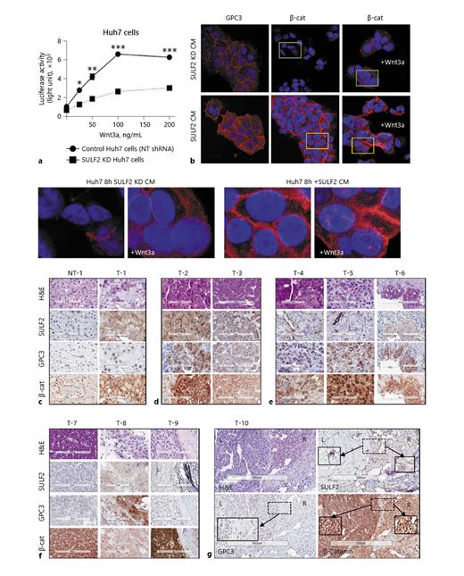 Fig. 4. SULF2, Glypican-3 and β-catenin in HCC. In HuH7 cells which overexpress SULF2 (a), addition of Wnt3a ligand stimulated a TOPFLASH β-catenin (β-cat) reporter, abrogated by SULF2 KD. b Confocal immunofluorescence staining of HuH7 cells showed low levels of glypican-3 (GPC3) and β-catenin in the presence of CM from COS-7 KD cells, +/− Wnt3a 100 ng/mL. In the presence of SULF2-CM, GPC3 and membranous β-cat were upregulated. There was evidence of nuclear β-cat in the presence of Wnt3a (magnified images). c–g Haematoxylin and eosin images, with SULF2, glypican-3 and β-catenin immunohistochemistry is shown for 10 cases. A non-tumour (NT) case is in (c), with the corresponding tumour (T) showing tumour cells SULF2+, nonspecific nuclear GPC3, and nuclear β-cat. Panel (d) shows two SULF2+ HCC with grade 1–2 GPC3+ and nuclear β-cat. In (e), three CAF-SULF2+ cases show grade 1–2 GPC+ and nuclear β-cat. T7 (f), however, has no SULF2 or GCP3, but nuclear β-cat++; T8 has scant SULF2, grade 2 GPC3 and no nuclear β-cat, while T-9 is CAF-SULF2+, GPC3−, and β-cat++. T10 is from a resection, showing tumour heterogeneity, with mild tumour SULF2+ (right [R]), with nuclear β-cat, while a region with CAF-SULF2+ (left [L]) shows membranous accumulation of β-cat. GPC3+ was classed negative, with absent cytoplasmic or membranous stain in both areas.