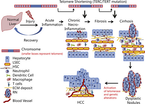 Fig. 1. Diagrammatic representation of various pathological changes associated with liver disease progression. Necroinflammation and telomere shortening are hallmarks of the early stages of chronic liver disease that finally lead to fibrosis and cirrhosis. Some regenerating nodules in the cirrhotic liver show atypical cells that progress toward dysplasia and culminate as a neoplastic lesion. Neoplasia is accompanied with telomerase activation and accumulations of genetic/epigenetic alterations (see fig. 5).
