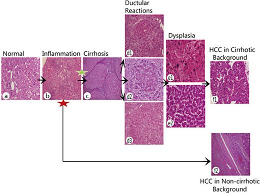 Fig. 2. Chronological representation of histopathological events during progression toward HCC. The majority of HCC lesions occur against a cirrhotic background (green asterisk), whereas in rare instances it can also occur against a noncirrhotic background (red asterisk). Typical histopathology sections during disease progression are shown: (a) normal liver (×200), (b) chronic hepatitis with marked portal/peri-portal chronic inflammation (×100), (c) cirrhosis with regenerating parenchymal nodules separated by active fibrous septa (×40), (d1) ductular reaction in cirrhosis (×100), (d2) ductular reaction with different stages of differentiation toward hepatocytes in a regenerating nodule (×200), (d3) large cell changes in regenerating nodule in cirrhosis (×100), (e1) large cell dysplasia (×200), (e2) small cell dysplasia (×200), (f1) HCC with thick trabeculae of malignant hepatocytes (×200) and (f2) HCC with trabeculae and pseudoacinar transformation in a noncirrhotic background (×40).