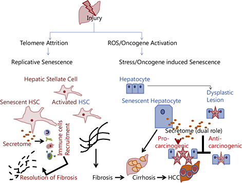 Fig. 6. Opposing roles of cellular senescence depending on cell type and the pathological state of the liver. The secretome phenotype of senescent cells makes them active immunomodulators. In a cirrhotic background, the senescence of HSCs is beneficial for the resolution of fibrosis; in contrast, accumulation of hepatocyte senescence is a hallmark of cirrhosis. The senescent hepatocyte, through its secretome activity, can help in clearing neoplastic cells and thus have an anticarcinogenic effect; however, in later stages of disease progression, the secretome can act as a procarcinogen influencing the proliferation of neighboring parenchymal cells or stem cells. ROS = reactive oxygen species.