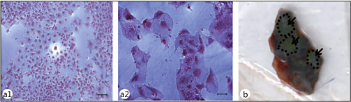 Fig. 7. Hepatic senescence. (a) HCC cell line Huh7 without (a1) or with doxorubicin treatment (a2). Note that the senescent cells (a2) showed an enlarged morphology, a typical feature of stress-induced premature senescence, as a result of the action of doxorubicin. Cells were stained with hematoxylin and eosin. Scale bar =10 µM. (b) Cirrhotic liver tissue stained positive for senescent associated β-galactosidase activity. The dotted lines and arrow indicate the cirrhotic nodules. Note the blue staining in the cirrhotic liver.