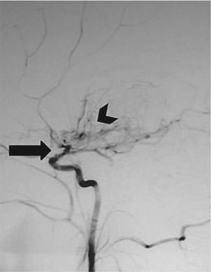 Fig. 1. Cerebral angiogram showing occlusion of the distal internal carotid artery (arrow) and characteristic ‘puff of smoke' appearance (arrowhead).