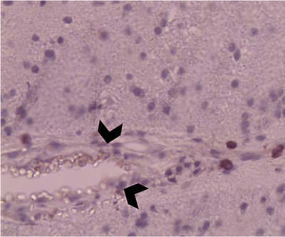 Fig. 2. Brain biopsy (hematoxylin and eosin stain) showing lymphocytic infiltration of the vessel wall (arrowheads) and perivascular tissue, suggestive of vasculitis.