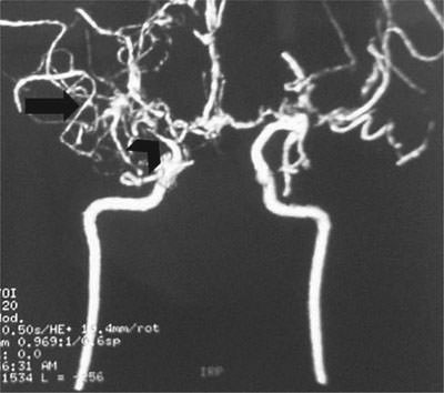 Fig. 3. Follow-up CT angiography at 6 months showing stenosis and occlusion at the terminus of the internal carotid arteries (arrowhead) and extensive collateral formation (arrow).