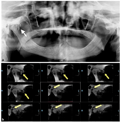 Fig. 1. a Panoramic radiograph of case 1. Arrow shows loose bodies anterior to the mandibular condyle at the right side. b Cross-sectional sagittal view images; arrows show irregular-type loose bodies on anterior and superior aspects of the right condyle.