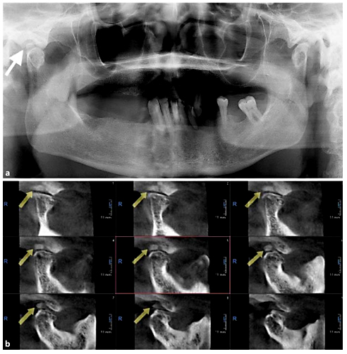 Fig. 2. a Panoramic radiograph of case 2. Arrow shows loose body superior to the mandibular condyle at the right side. b Cross-sectional sagittal view images; arrows show loose body on superior aspect of the right condyle.