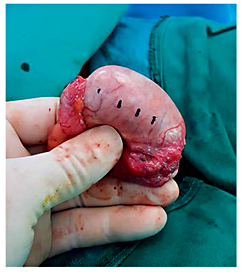 Fig. 1. Color marking of the testicle at the site of planned sutures to avoid the vessels.