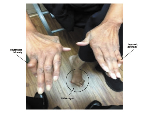 Rheumatoid Arthritis: A Brief Overview of the Treatment | Medical ...