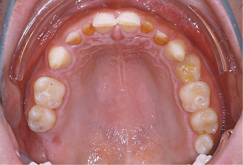 Fig. 3. A 21-year-old male patient with odonto-onychodermal dysplasia. Despite oligodontia he was initially diagnosed at the age of 20 years.