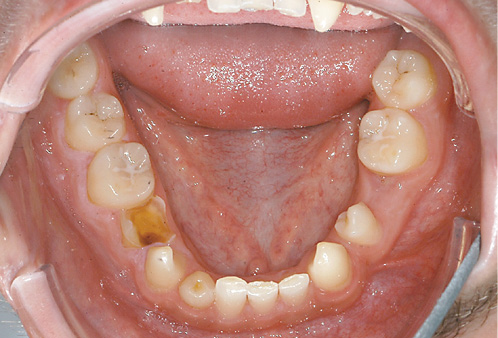 Fig. 4. A 21-year-old male patient with odonto-onychodermal dysplasia. Despite oligodontia he was initially diagnosed at the age of 20 years.