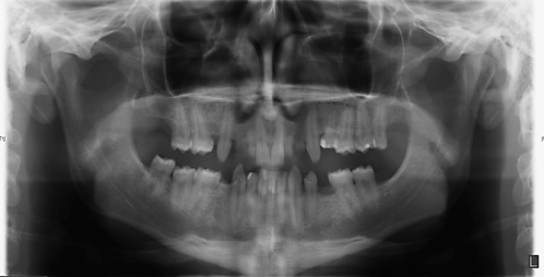 Fig. 5. A 21-year-old male patient with odonto-onychodermal dysplasia. Despite oligodontia he was initially diagnosed at the age of 20 years.