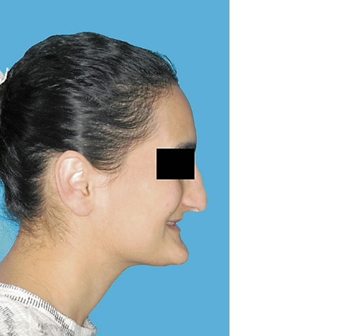 Fig. 6. A 29-year-old female patient with odonto-onychodermal dysplasia. Despite dysgnathia and oligodontia she was initially diagnosed at the age of 29 years.