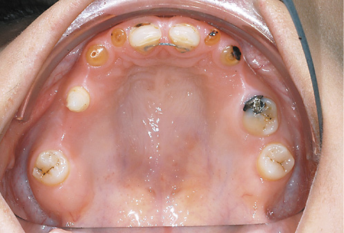 Fig. 7. A 29-year-old female patient with odonto-onychodermal dysplasia. Despite dysgnathia and oligodontia she was initially diagnosed at the age of 29 years.