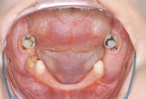Fig. 8. A 29-year-old female patient with odonto-onychodermal dysplasia. Despite dysgnathia and oligodontia she was initially diagnosed at the age of 29 years.