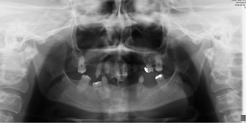 Fig. 9. A 29-year-old female patient with odonto-onychodermal dysplasia. Despite dysgnathia and oligodontia she was initially diagnosed at the age of 29 years.