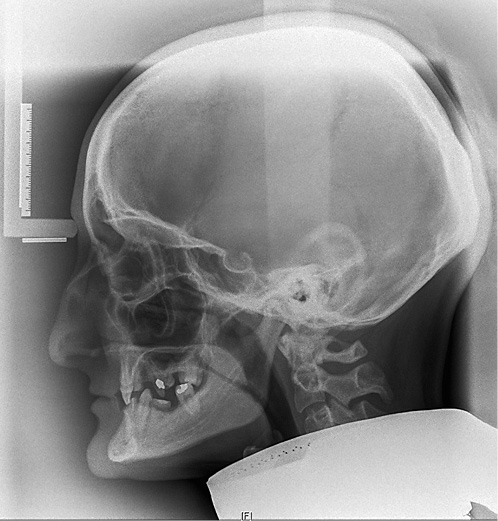 Fig. 10. A 29-year-old female patient with odonto-onychodermal dysplasia. Despite dysgnathia and oligodontia she was initially diagnosed at the age of 29 years.