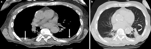 Fig. 1. Reported incidental findings in an 85-year-old male patient. Axial CT images with mediastinum (a) and lung (b) windowing showing bilateral pleural effusion (straight arrows) and parenchymal consolidation at the left pulmonary base (curved arrow).