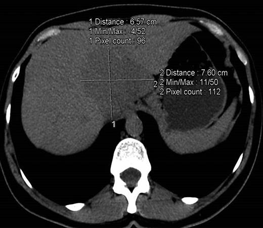 Fig. 2. Unreported incidental finding in a 43-year-old female patient. Axial CT image showing a hypodense 6.6 × 7.6-cm lesion at the hepatic dome.