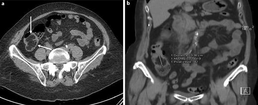 Fig. 3. Unreported incidental finding in a 50-year-old female patient. Axial (a) and coronal reformatted (b) CT images showing a markedly hypodense 3.4-cm lesion in the lumen of the right colon (arrows), representing a lipoma.