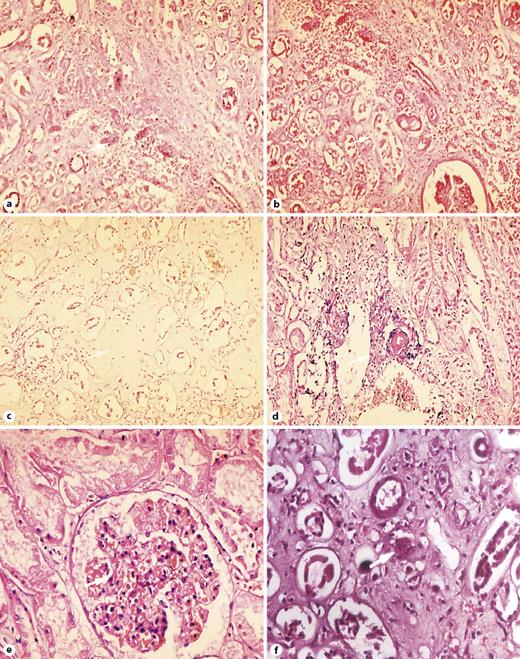 Fig. 1. Histopathological data on renal impairment in patients with MSF; cortical vasculitis with perivascular inflammatory mononuclear cell infiltration (a); hyaline microthrombi (arrowheads), interstitial edema and microhemorrhages, extensive interstitial inflammatory mononuclear cell infiltrate (b); insudation of blood plasma in the walls of the arterioles, interstitial edema, tubular necrosis of the proximal tubules (arrowheads) c Kidney medulla interstitial edema (arrowheads). Renal border zone (cortex-medulla) – vasculitis with fibrinoid necrosis, necrosis of epithelial cells in the proximal tubules (arrowheads) (d); glomerulus – acute blood stasis; swelling in the mesangium (e); proteinuria in the Bowman’s space (arrowhead); kidney – hyaline thrombus in an arteriole (arrowhead) (f). a–d, f – hematoxylin-eosin staining, original magnification × 200; hematoxylin-eosin staining (e), original magnification × 400. MSF, Mediterranean spotted fever.