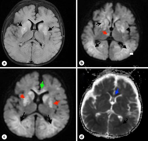 On a, T2 axial FLAIR images show bilateral hyperintensities on both nucleus caudatus and basal ganglions. The black arrows on a show the affected areas on basal ganglions. b, c show DWI images of the involvement of both bilateral occipital lobes and parahippocampal regions, right thalamus (red arrow on b), and anterior part of corpus callosum. However, the posterior part of corpus callosum is spared. On b, the black arrows show the bilateral occipital regions, the arrow head in the front shows the bilateral basal ganglions, and the red arrow shows the right thalamus involvement. On c, the occipital lobes are shown with black arrows, the red arrow shows basal ganglions, and the anterior corpus callosum is shown by green arrow. On d, due to correspondence to DWI, there is a diffusion restriction on ADC-weighted images. The blue arrow shows the anterior corpus callosum diffusion restriction and the curved arrow shows the affected areas on the occipital region.