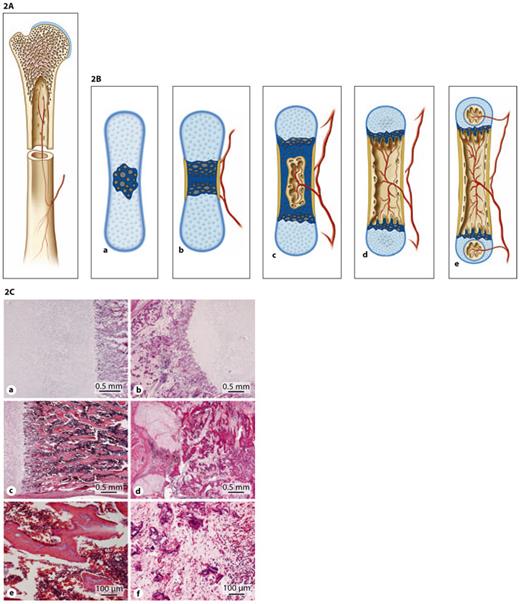 Fig. 2. A Compact and spongy bone. B Endochondral ossification. Endochondral ossification occurs when mesenchymal cells differentiate into chondroblasts that produce a cartilage matrix. This cartilage acquires the shape of the bone that will be formed. A periosteal collar of bone forms around the diaphysis. Osteoblasts in this region are engaged in periosteal bone formation, which is responsible for the growth in thickness of long bones. In the centre of the diaphysis chondroblasts hypertrophy, the cartilage matrix becomes calcified, blood vessels and connective tissue cells evade the calcified cartilage, creating a marrow cavity (primary ossification center). Trabeculae of calcified cartilage (primary and secondary spongiosa) remain at the 2 ends of the cavity on which endochondral bone forms (secondary ossification centers). C Histologic abnormalities in OI compared to a control. Panels a, c and e show histology of a normal control femur at 18 weeks of gestational age (GA). Panels b, d and f are from an 18-week GA type II OI case. The transition zone of cartilage to primary spongiosa is sharp in both cases (a, b). Minor disruption can occur due to fractures and scar formation in the primary spongiosa (not shown). Panel d shows extensive metaplastic cartilage formation at the sight of a fracture. The bony trabeculae are hypercellular and the marrow is fibrotic. Panel e shows normocellular trabeculae and hematopoietic marrow between these trabeculae. In the severe OI cases, the trabeculae are thin, irregular and hypercellular in comparison with normal trabeculae (f). The marrow in between is fibrotic with hardly any hematopoiesis (d, f).