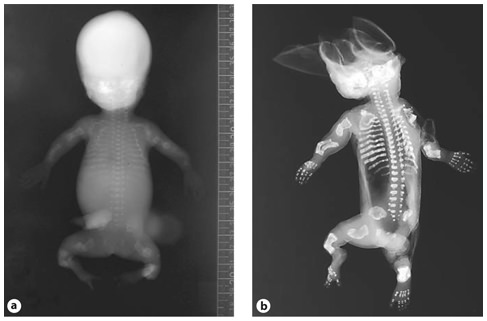 Fig. 4. A OI type II-A in a preterm infant. Skeletal overviews without (a) and with (b) silver nitrate impregnation show generalized osteopenia with diminished ossification of the calvarian bones and gross skeletal deformation. No vertebral anomalies are seen. The ribs are broad with continuous fractures (continuous beading). The long bones show multiple fractures and are shortened, deformed and broadened. Clinical synopsis: It concerned the second pregnancy of a nonconsanguineous Caucasian couple. At a gestational age of 21 weeks, ultrasonographic abnormalities were seen. All long bones were severely shortened (<p5). Bowing of the humeri and the femora was observed. The skull appeared somewhat doligocephalic with a remarkable clear imaging of the cerebrum and could be deformed by pressure of the ultrasound transducer. The parents decided to terminate the pregnancy, and a child was born at a gestational age of 22+3 weeks with a birth weight of 160 g. A skeletal overview revealed an almost total absence of skull mineralization and multiple fractures of the ribs and the long bones consistent with a diagnosis of OI type II-A. Bone histology showed hypercellular irregular trabeculae with multiple fractures, fibrotic marrow and metaplastic cartilage formation. On collagen electrophoresis, post-translational overmodification was observed. A causative variant in the COL1A1 gene was found (c.2300G>A; p.Gly767Asp). B Perinatal OI type II-A. a Skeletal overview of a 35+4-week-old fetus with OI type II-A shows multiple fractures of both the long bones as well as the ribs. Note the under mineralization of the skull and its deformity on the left side. b Detail of the lower extremities shows multiple consolidated fractures resulting in deformed growth of the femurs, tibiae and fibulae. c Lateral radiograph of the lumbar spine shows mild platyspondyly (arrow). Clinical synopsis: It concerned the first pregnancy of a nonconsanguineous Caucasian couple. At a pregnancy duration of 35+4 weeks, a boy was delivered by caesarean section. Apgar scores were 4/4/4 after 1, 5 and 10 min, respectively. Birth weight was 1,100 g. Blue sclerae with proptosis were visible. The thorax was small and bell-shaped. Fractures of the ribs were felt. Gasping breath with insufficient thorax excursions was apparent. Auscultation of the heart revealed bradycardia with no other anomalies. The skin was thin and fragile with a large skin defect temporo-occipital. The extremities were short and deformed. The child died 30 min after birth due to severe respiratory and circulatory insufficiency. A skeletal overview was consistent with a diagnosis of OI. Histology showed decreased osteoid formation at the level of the primary spongiosis in combination with decreased numbers of osteoblasts and osteoclasts. A causative variant in the COL1A1 gene c.1804G>A; p.Gly602Arg was found.