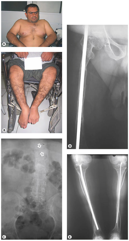 Fig. 7. Clinical pictures and radiographs of a patient with OI type IV. A, B White sclerae, muscular upper extremities, wheelchair bound. C AP radiograph of the abdomen, of poor quality, shows a compression fracture of T10 (between arrows). D, E Radiographs of the lower extremities show reduced bone density and thin tibia shafts with both fibula being very thin and tortuous. Intramedullary rods are in position. Clinical synopsis: A 33-year-old Iranian man consulted a clinical geneticist when his wife was pregnant as he wanted to be informed about the chance of recurrence of OI in his unborn child. His height and head circumference are, respectively, 145 cm (–5.5 SD) and 57 cm (–0.5 SD). He claims he has had multiple fractures first occurring at 2 years of age. Unfortunately, no documented medical history is available. His sclerae are greyish. No hearing loss or DI is present. His father and sister were also known to be affected with OI. MLPA analysis of the COL1A1 gene showed a partial deletion of COL1A1(exon 6–51).