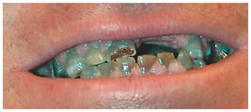 Fig. 9. DI in a patient with OI type III.