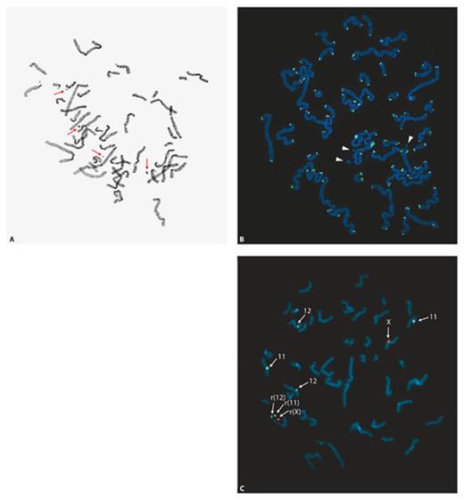 Fig. 1. Up to 4 small supernumerary ring chromosomes were found in metaphases of the proband. A Metaphase after Giemsa staining showing 4 small supernumerary marker chromosomes (sSMCs; indicated by arrows). Most metaphases contained 3 or 2 sSMCs. B Three of the sSMCs (indicated by arrowheads) are ring-shaped because they were not labeled by a telomere-specific TTAGGG peptide nucleic acid probe. C Three of the sSMCs originate from chromosomes 11, 12 and X, respectively, as shown by FISH using CEP 11 (locus D11Z1, blue), CEP 12 (locus D12Z3, green) and CEP X (locus DXZ1, red) as probes (all from Abbott-Vysis).