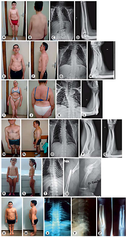Fig. 1. Patients and radiological findings. Case 1: A, B Patient images. C Throracolumbar scoliosis and irregular rib positions. D CIM. Case 2: E, F Patient images. G Thoracic scoliosis and irregular rib positions. H CIM. Case 3: I, J Patient images. K Severe cervicothoracolumbar scoliosis. L CIM. Case 5: M, N Patient images. O Thoracic scoliosis and rib deformities. P, Q CIM and DRH. Case 6: R, S Patient images. T Reduction of height of vertebral bodies, scoliosis and rib deformities. U HPC after femur fracture. Case 7: V, W Patient images. X, Y Reduction of height of vertebral body and rib irregularities. Z CIM.