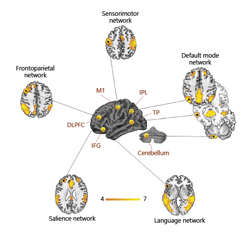 Fig. 2. Common targets of NIBS reported in the literature (yellow spheres on 3D brain) are major nodes of large-scale functional networks. Each target can be used as a seed to derive functionally related (i.e., synchronous) regions of the brain. Stimulation of specific brain regions results in both local and distal functional connectivity modulation. Orange-yellow colors on axial slices represent the intrinsic functional connectivity degree (z score) of the major large-scale networks, extracted through independent component analysis from a sample of 20 healthy subjects.